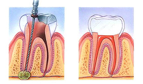 Root canal therapy in Olympia, WA